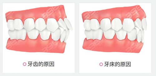 凸嘴正颌手术有必要吗？