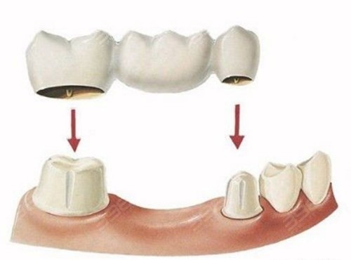 活动假牙的优点:适用于全口多数牙齿缺失,单颗牙齿缺失,也是较早的一