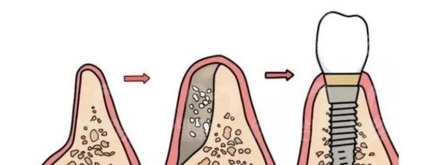 75岁老人牙槽骨萎缩能做种植牙吗?种植医生是这么回答的