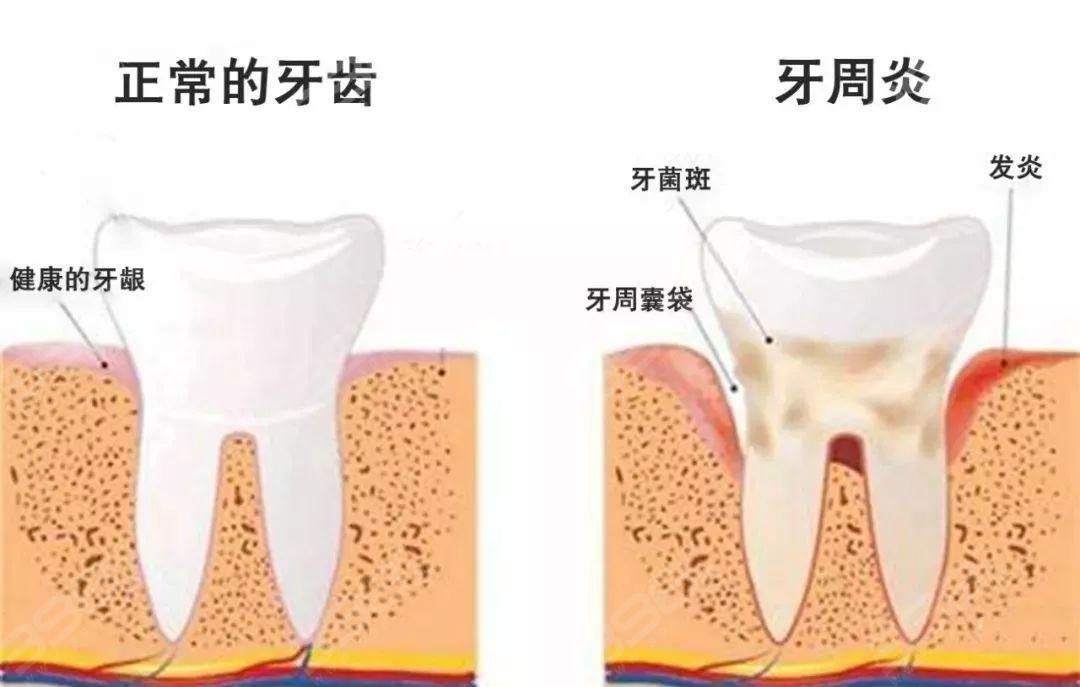 牙周炎