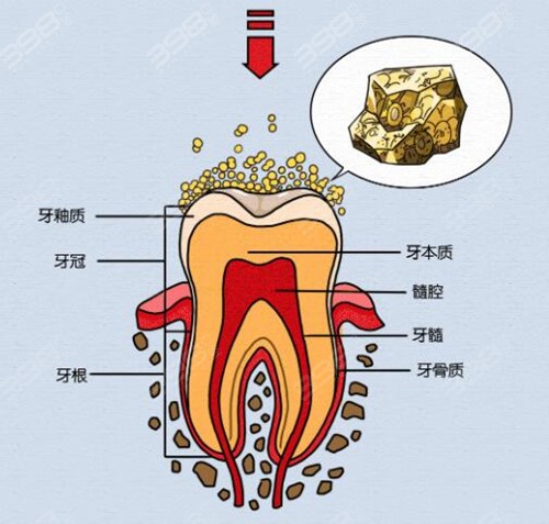 牙菌斑