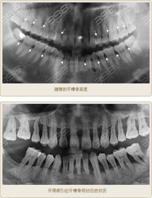 缺牙10年后可以种牙吗