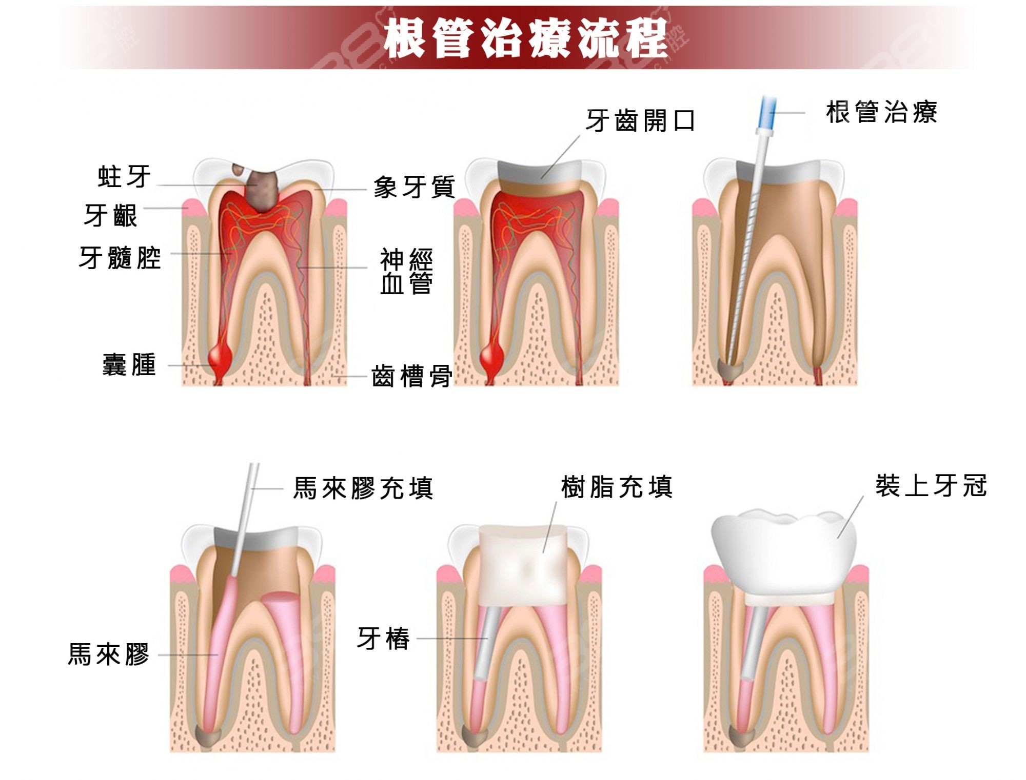 牙髓组织红蓝铅笔图图片