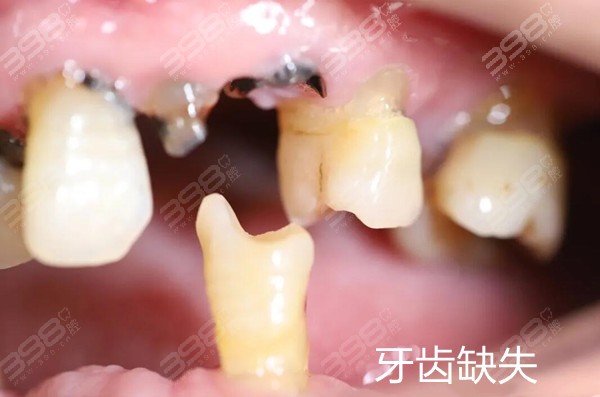 缺牙10年后可以种牙吗?牙槽骨吸收多少决定种植牙难度与价格