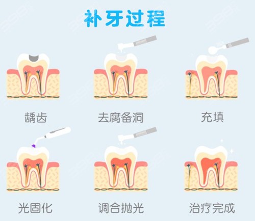 补牙过程