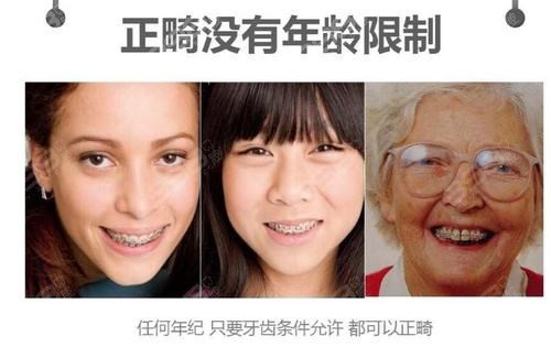 先了解清楚牙齿矫正的5个误区在纠结牙齿到底要不要矫正