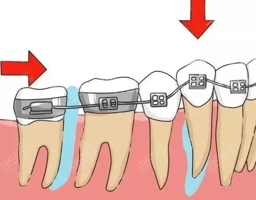 牙齿矫正常见误区