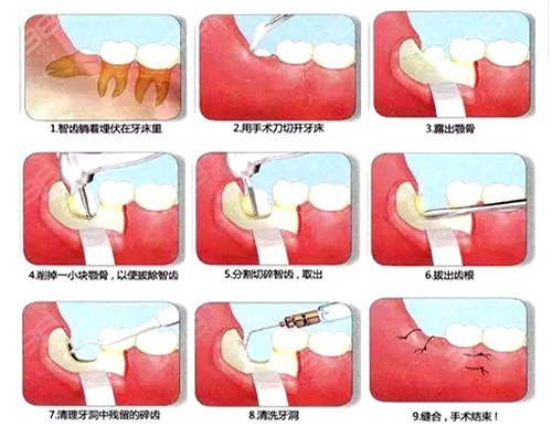 阻生齿拔牙过程