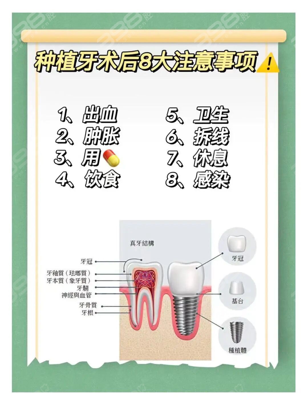 上颌窦提升术后注意事项