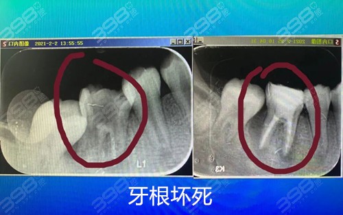 补牙牙洞会越补越大吗