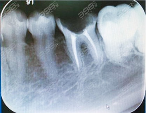 根管治疗后的牙齿