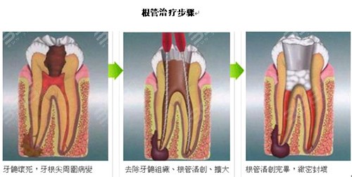 普通根管治疗