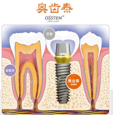 韩国种植体牙多少钱一颗