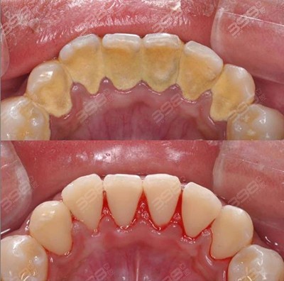 洗牙前和洗牙后的照片图片