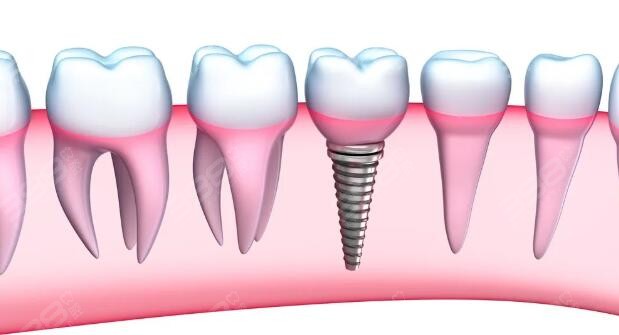建议镶牙不建议种植牙
