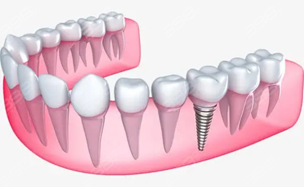 种植牙和真牙一样美观