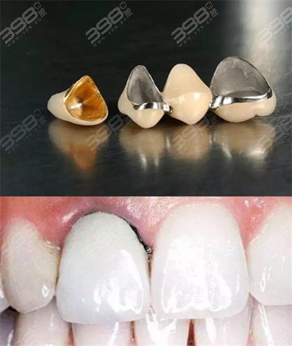 烤瓷牙冠和牙龈交界处发黑正常吗上海哪个牙科可以修复烤瓷冠