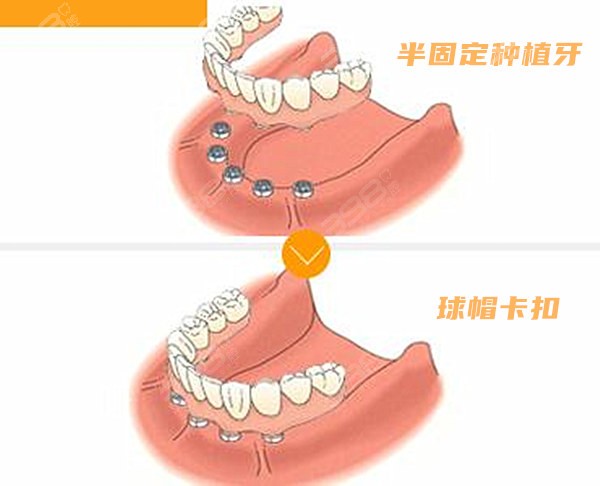 种植须知半口种植方案比较看不同方案的半口种植价格大约多少钱