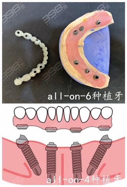 汉阳区全口牙多少钱?