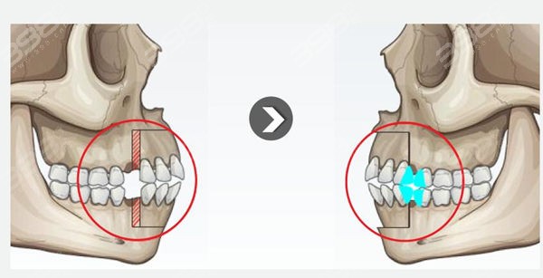 龅牙,偏颌,地包天等一系列矫正无法改善的问题的手术,通过截骨,内推