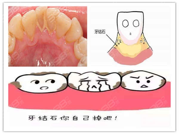 牙结石