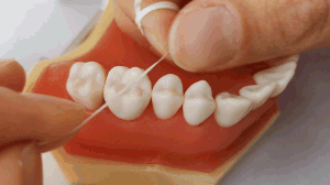 牙线卷