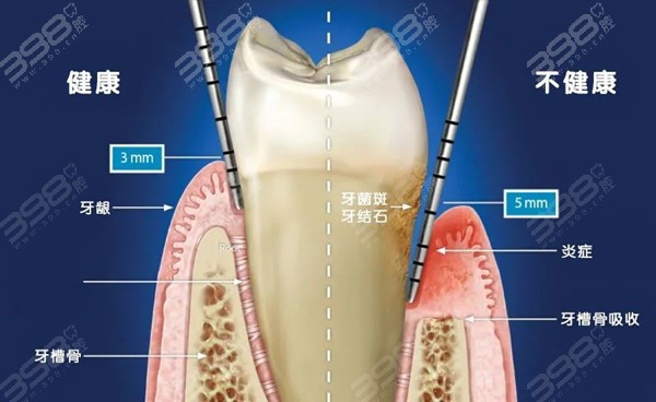 牙周炎是什么原因引起的