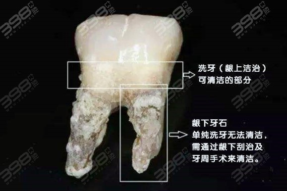 牙周刮治后牙龈萎缩好好的