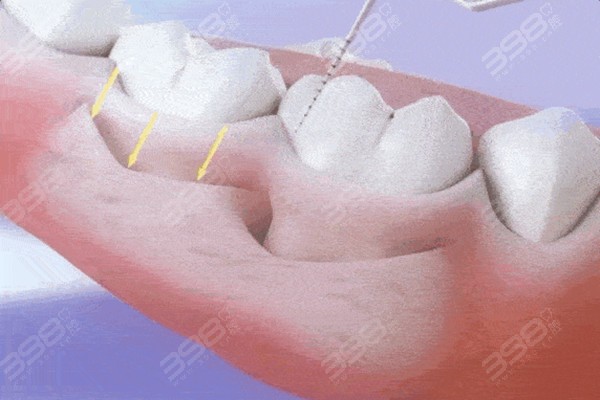 你做牙周刮治多少钱一次治疗步骤图揭秘对牙龈有损伤吗