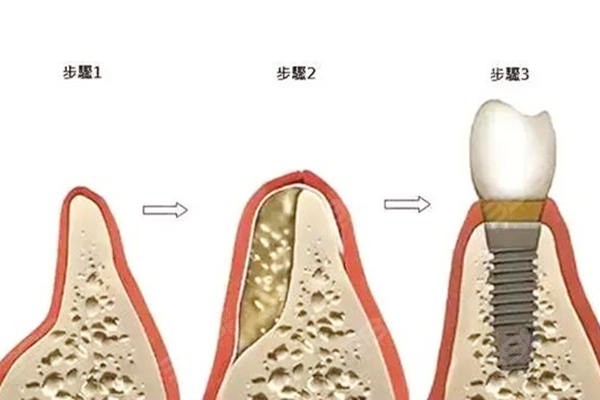 牙槽骨吸收了还可以种植牙吗如果没有牙槽骨可以种牙吗