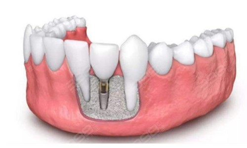 种植牙图片