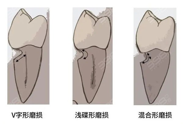 楔状缺损形态