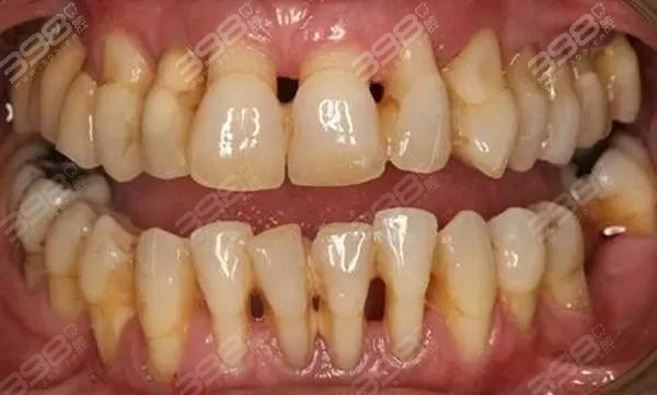 门牙牙龈萎缩严重图图片
