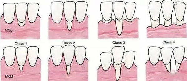 牙龈萎缩和正常牙龈图片对比 看看你的牙龈还有救吗?