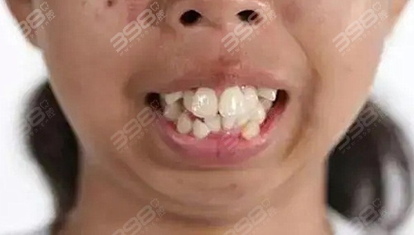 位都是是轻微凸嘴和龅牙的表现,这类凸嘴问题可以通过矫正牙齿来改善