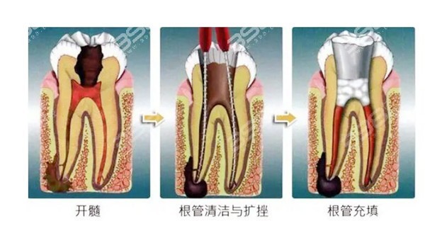 根管治疗示例图