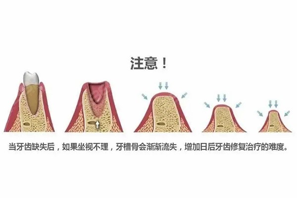 里面大牙全没了可以不种植吗