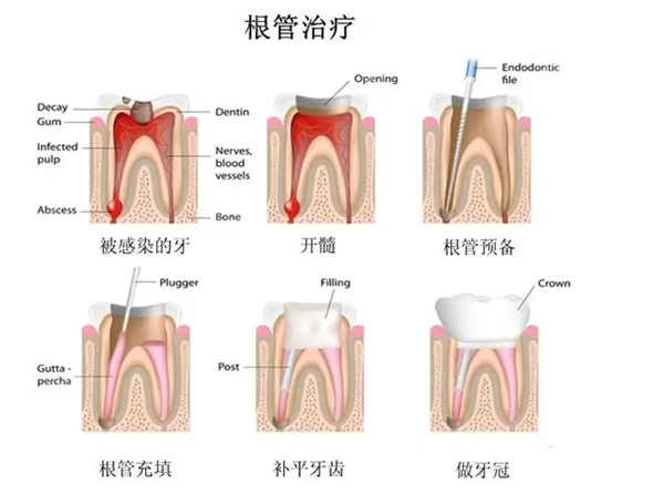 濮阳根管治疗需要多少钱