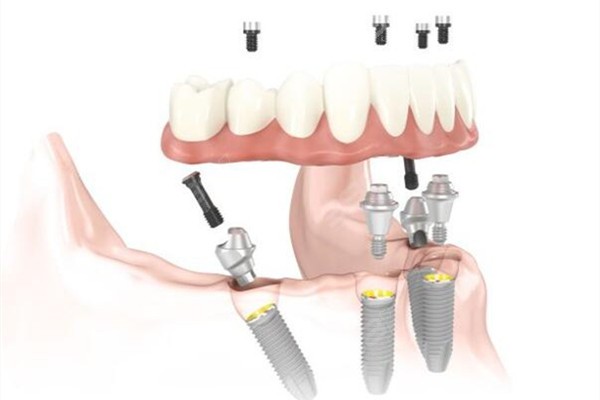 all-on-4全口种植技术