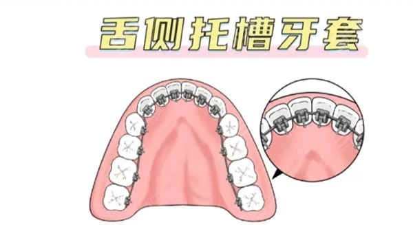 南宁牙齿矫正一般多少钱