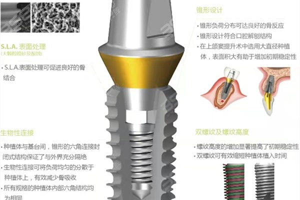 正规医院种植牙收费标准