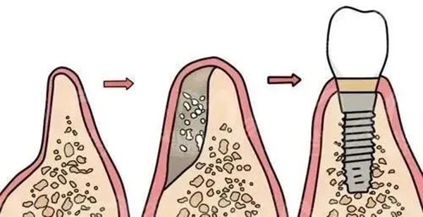 植骨种植牙
