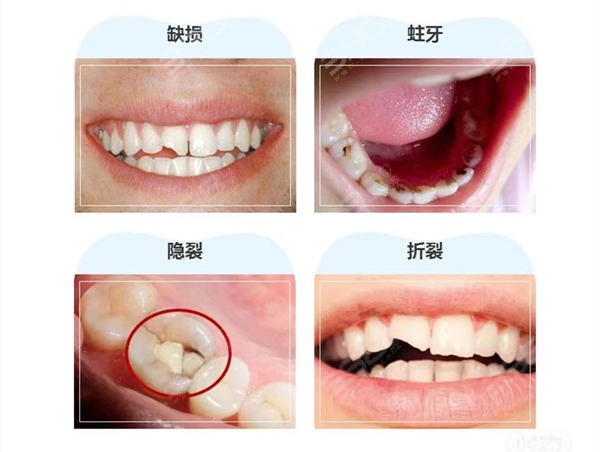 牙齿会断裂