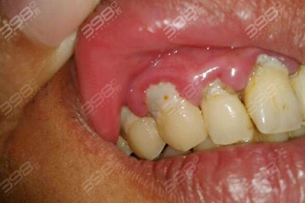 为什么牙齿上面抠下来的白色东西很臭牙科医生说出答案