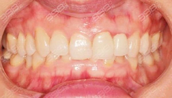 不同牙齿错颌畸形问题矫正方案会有不同,这里不能统一分享给你,不过