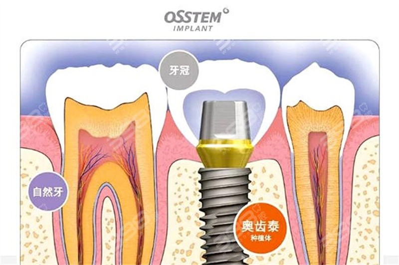 韩国奥齿泰种植牙