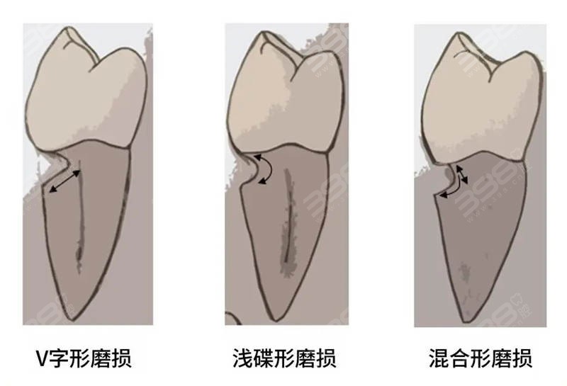 楔状缺损