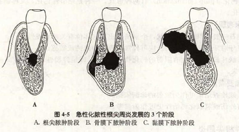 牙周炎