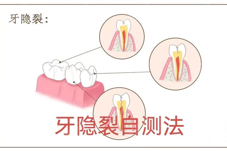 一吃冷热牙就酸疼怎么办