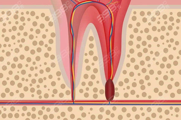 牙根尖发炎的危害